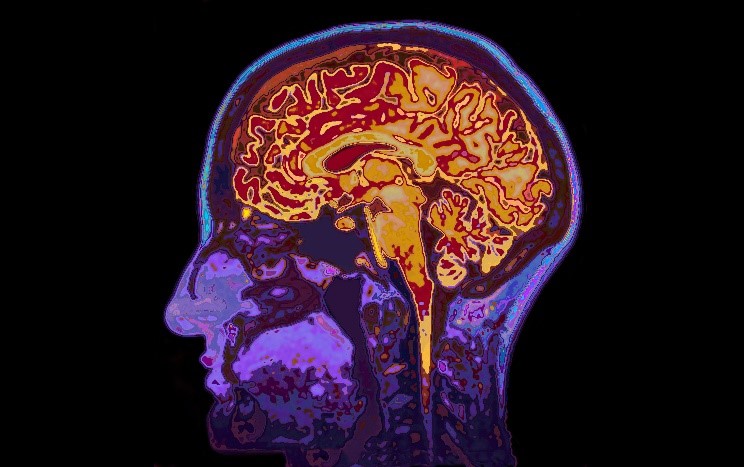Brain Scan