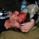 Protestor Injured by Police at Occupy Oakland